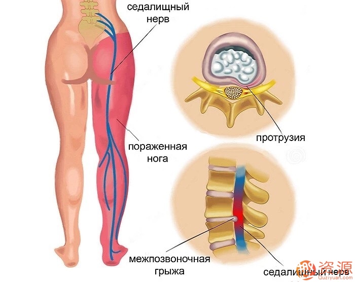 腰椎间盘突出康复训练插图2